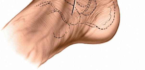 Illustration 17 for Optimized Approaches to the Dorsum of the Foot & Ankle