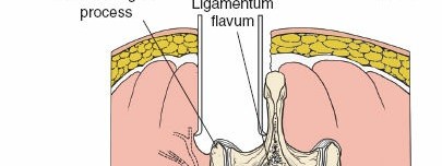 Illustration 12 for Approach to the Lumbar Spine: Mastering Techniques & Anatomy