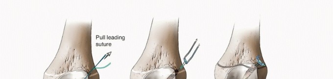 Illustration 23 for Optimizing ACL Reconstruction for Skeletally Immature Patients