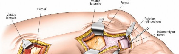 Illustration 55 for Optimal Femoral Approaches: Mastering the Lateral Intermuscular Septum