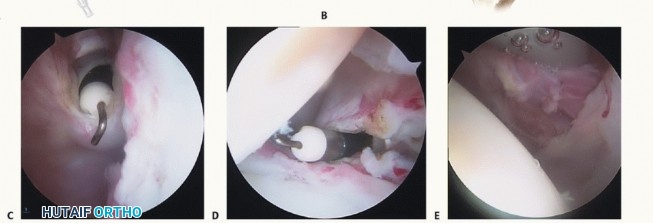 Illustration 17 for Stiff Shoulder? Discover Arthroscopic Capsular Release Solutions