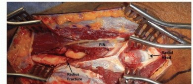 Illustration 24 for Optimal ORIF for Diaphyseal Forearm Fractures: Your Guide