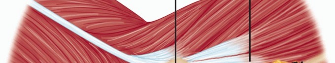 Illustration 24 for Radial Head & Neck Fractures: Mastering ORIF for Best Results