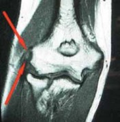 Illustration 2 for Unlock Relief: Arthroscopic Treatment of Epicondylitis Explained