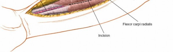 Illustration 8 for Mastering Approaches to the Upper Third of the Radius