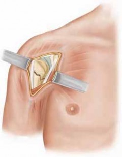 Illustration 11 for Mastering Pediatric Shoulder Fractures: Clinical Insights