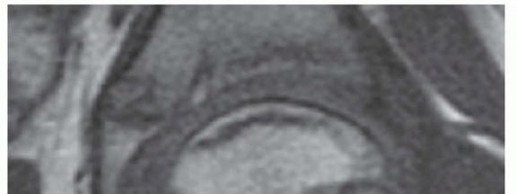 Illustration 3 for Labral Support Shelf Procedure: Preventing Perthes Deformity