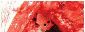 Illustration 18 for Why Polished Tapered Cemented Stems Excel in Hip Replacement