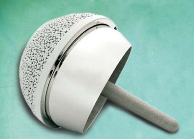 Illustration of hip resurfacing arthroplasty - Dr. Mohammed Hutaif