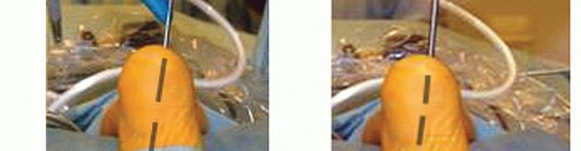 Illustration 7 for Posterior Talar Process: Endoscopic Solutions for Ankle Pain