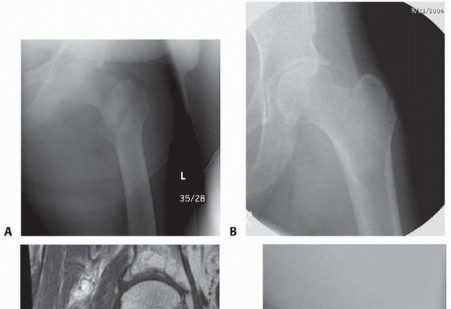 Illustration of peritrochanteric hip fractures - Dr. Mohammed Hutaif