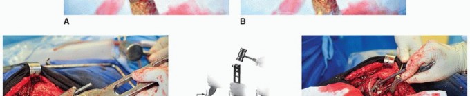 Illustration 39 for Cement in Cement Revision: Simplifying Complex Hip Revisions