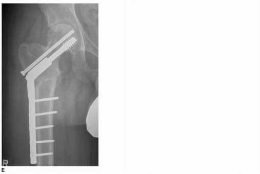 صورة طبية: جراحة قطع العظم حول الحُق وقطع عظم الفخذ: إعادة محاذاة مفصل الورك لراحة دائمة مع الأستاذ الدكتور محمد هطيف