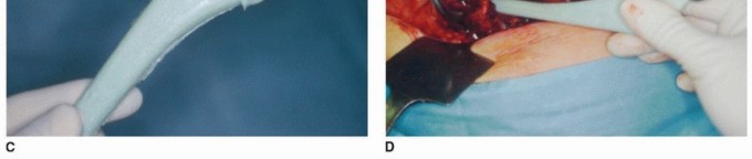 Illustration 6 for PJI of the Hip: Two-Stage Revision: When & How to Prepare