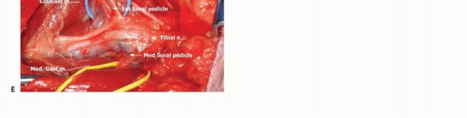 Illustration 17 for Complex Popliteal Resections: Protecting the Greater Saphenous Vein