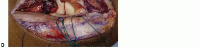Illustration 36 for Radial Head & Neck Fractures: Mastering ORIF for Best Results