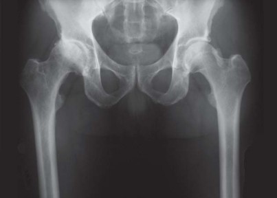 Illustration 28 for Avoiding Errors: Navigation in Total Hip Arthroplasty