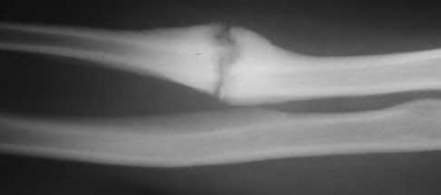 Illustration 155 for OrthoCash: Trauma MCQs & Cases for a yearold woman