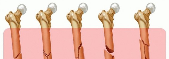 Illustration 5 for Retrograde Femoral Nailing: Optimizing Surgical Outcomes