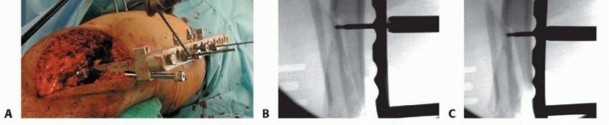 Illustration 54 for Repairing Distal Femur Fractures: Open Reduction & Internal Fixation