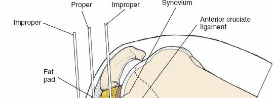 Illustration 126 for Surgical Access: Mastering the Tibia's Surface & Fibula Approaches