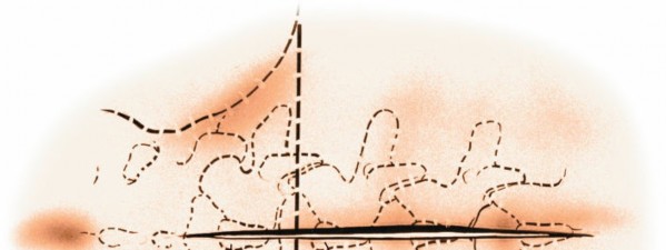 Illustration 5 for Mastering the Spine Posterior Approach: Surgical Essentials