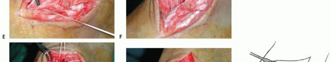 Illustration 30 for Medial Ankle Instability: Find Relief with Reconstruction