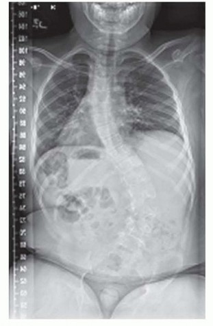 Illustration of rib to pelvis - Dr. Mohammed Hutaif