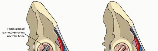 Illustration 11 for Head-Sparing for Osteonecrosis of the Femoral: Preserve Your Hip