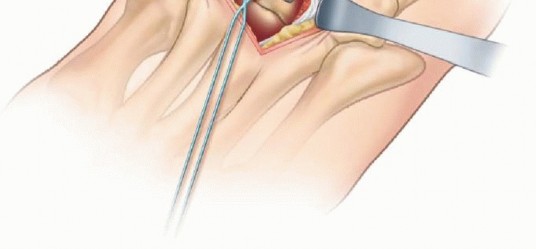 Illustration 13 for Why Anterior Tibialis Muscle Transfer Fixes Clubfoot