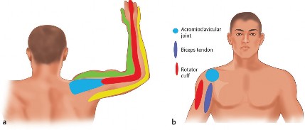 Shoulder-Spine Syndrome: Understanding Overlapping Neck & Shoulder Pain