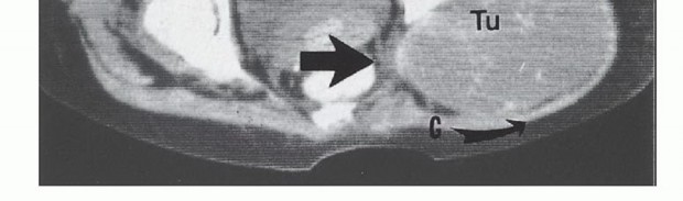 Illustration 5 for Anterior Flap Hemipelvectomy: Leveraging fig tech fig for Difficult Tumors