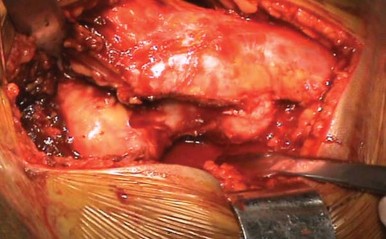 Illustration 6 for Unlock Movement: Arthroplasty for Bony Ankylosis Solutions