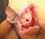 Illustration 27 for Knee Arthroplasty Unicondylar: Discover if Partial Knee Replacement is Right