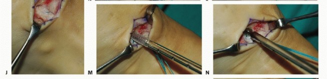 Illustration 20 for Foot Drop Surgery: How a Pin or Drill Elevates Tendon Transfer