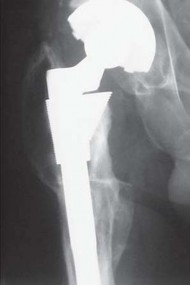 Illustration 8 for THA for patients with proximal femoral deformity: Practical solutions