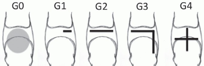 Illustration 10 for Plantar Plate Repair: End Lesser Toe Pain & Instability