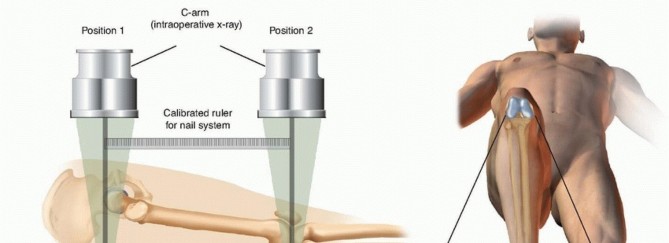 Illustration 14 for Retrograde Femoral Nailing: Optimizing Surgical Outcomes