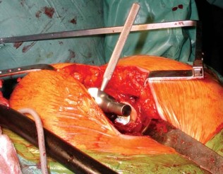 Illustration 32 for S-ROM: Inside the Technique of Modular Implant Design