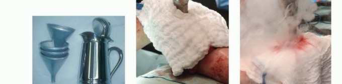 Illustration 8 for Avoid Major Surgery: Bone Tumor Treatment with Liquid Nitrogen Pour