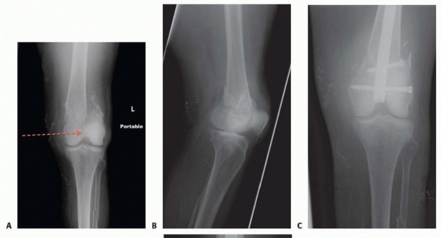 Illustration 23 for Repairing Distal Femur Fractures: Open Reduction & Internal Fixation