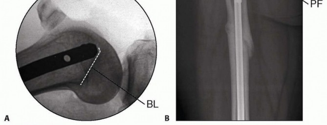 Illustration 18 for Retrograde Femoral Nailing: Optimizing Surgical Outcomes