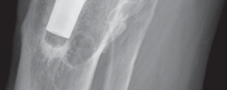Illustration 6 for Porous Metal Cones: Biologic Fixation for Severe Bone Loss