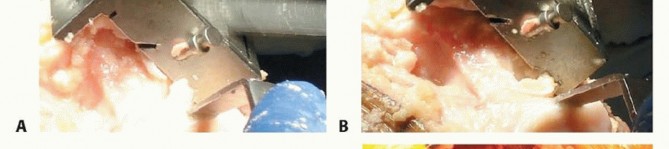 Illustration 28 for Achieve Lasting Pain Relief with Cemented Total Knee Arthroplasty