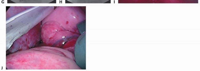 Illustration 23 for Anterior Interbody Arthrodesis for Scoliosis: What You Need to Know