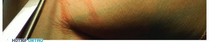 Illustration 43 for Radial Head & Neck Fractures: Mastering ORIF for Best Results