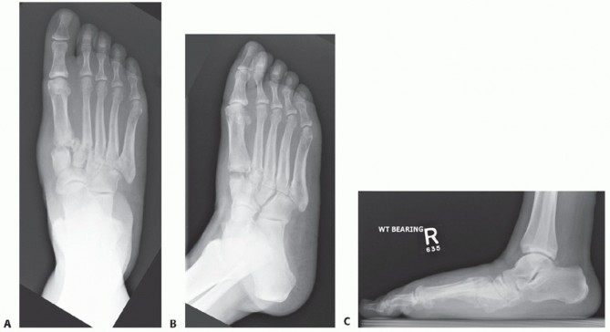 Illustration 41 for Mastering Midfoot Arthrodesis: Protect the Deep Neurovascular Bundle
