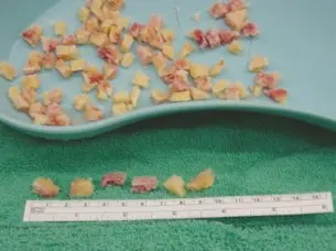 جراحة مراجعة مفصل الورك المعقدة وزراعة العظام بالضغط: حلول متقدمة لتعويض مفصل الورك الفاشل