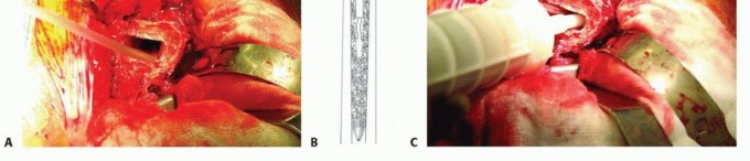 Illustration 25 for Exeter Hip Unit: Mastering Impaction Allografting for Femoral Bone Loss