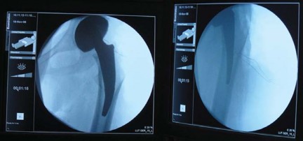 Illustration 19 for Considering METHA Short Stem? Discover Bone-Preserving THA